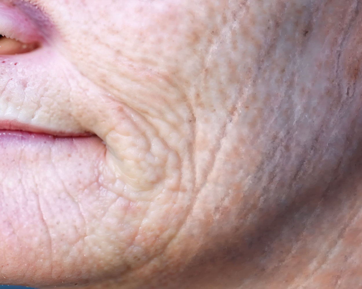 Antes do tratamento com Dermablate, caso clínico 1