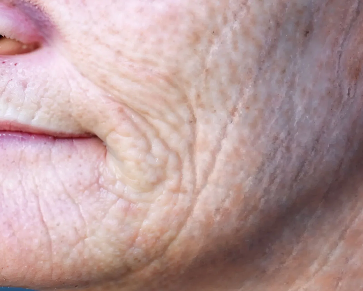 Antes do tratamento com Dermablate, caso clínico 1