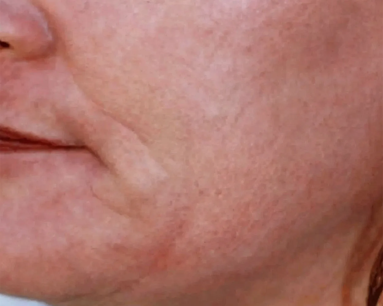 Depois do tratamento com Dermablate, caso clínico 1