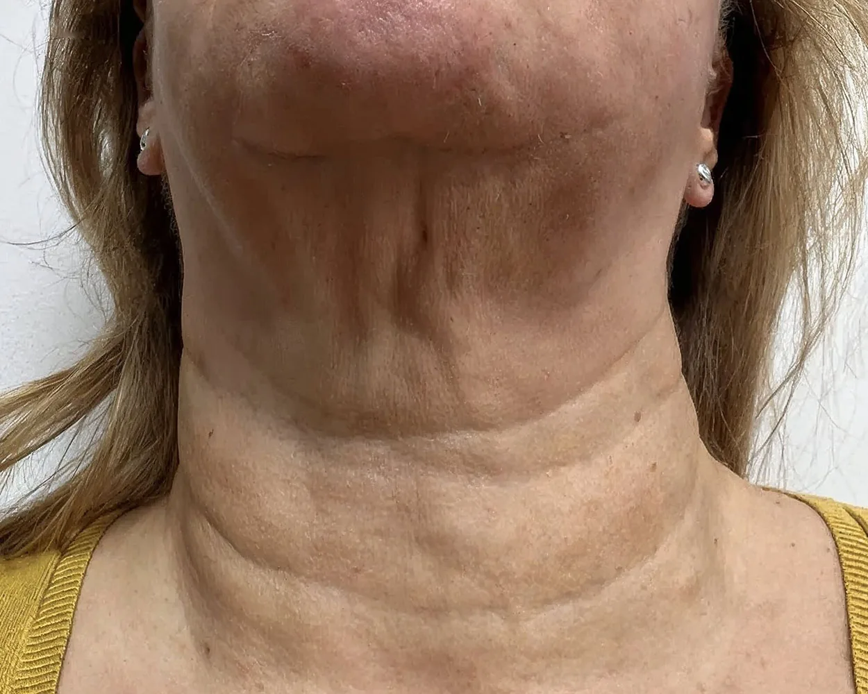 Antes do tratamento com Dermablate, caso clínico 2