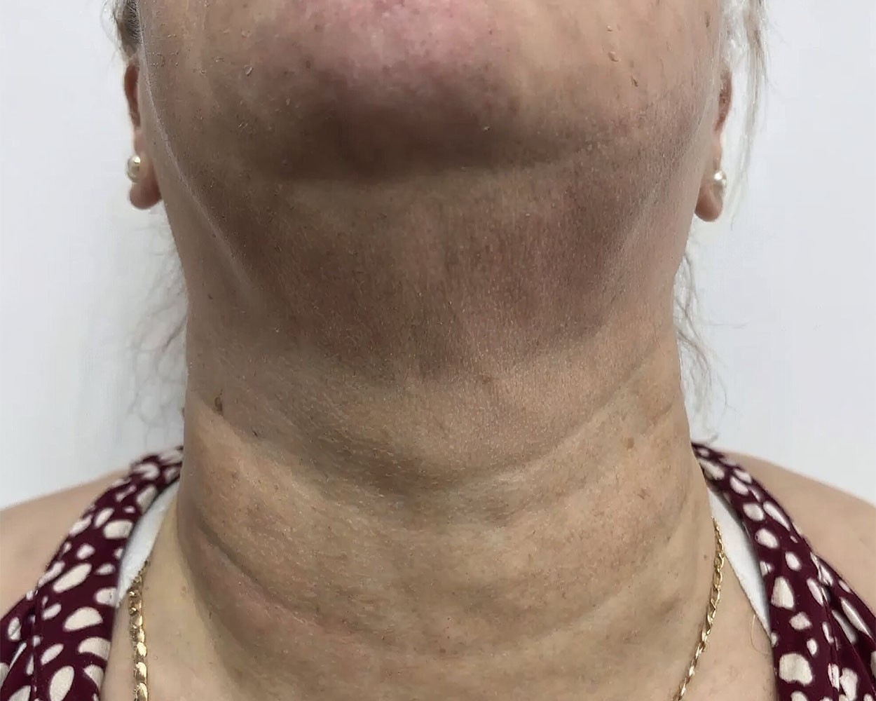 Depois do tratamento com Dermablate, caso clínico 2