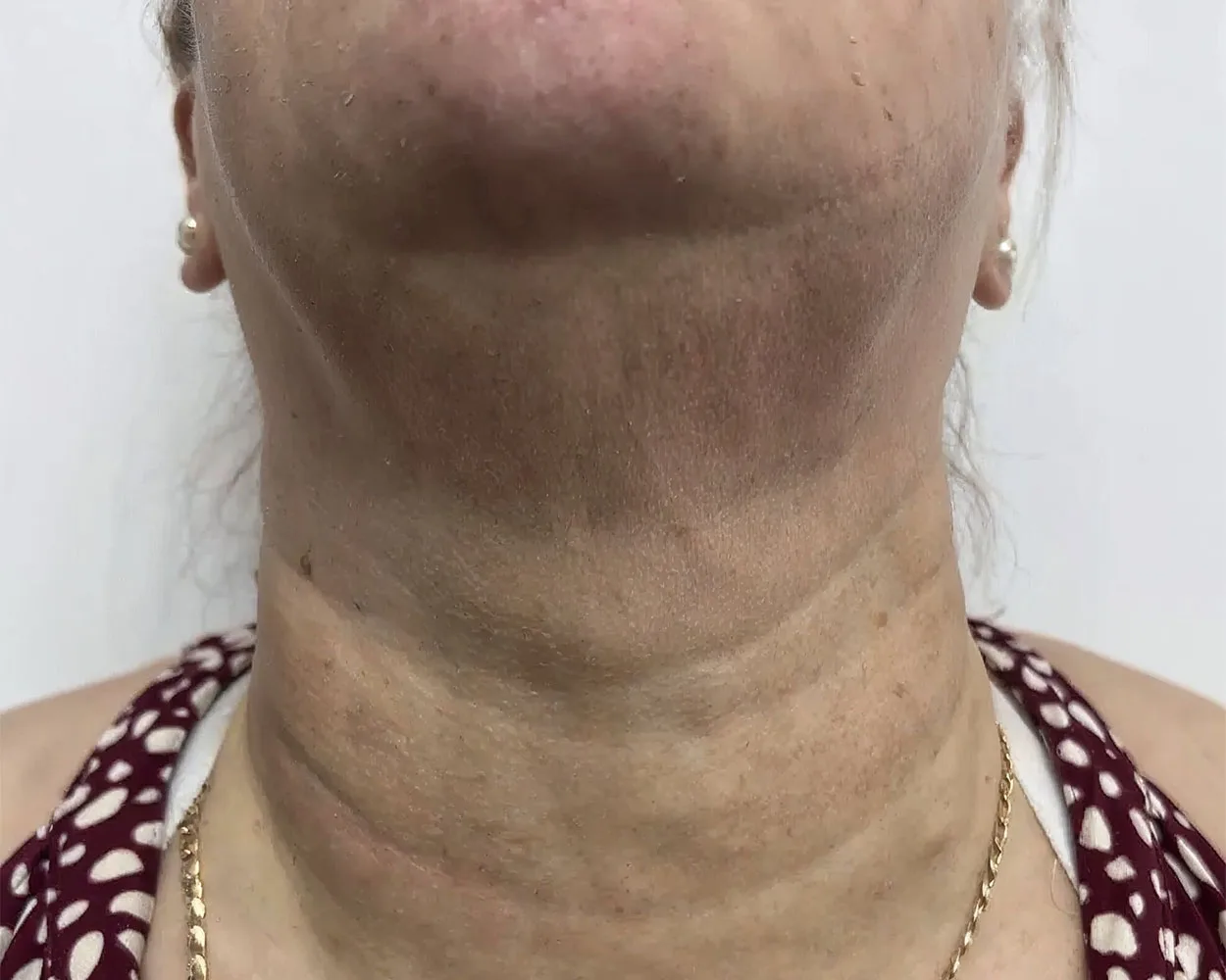 Depois do tratamento com Dermablate, caso clínico 2