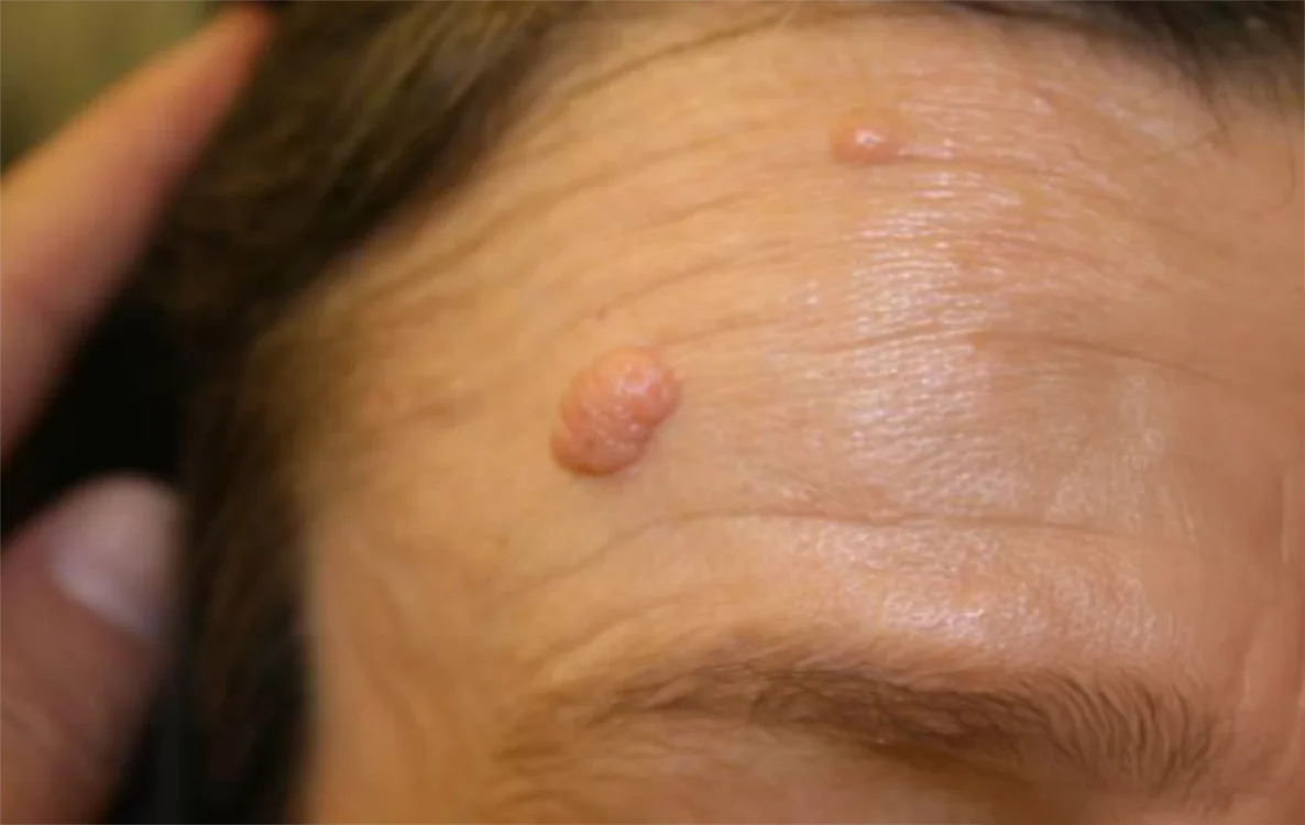 Antes do tratamento com Dermablate, caso clínico 3