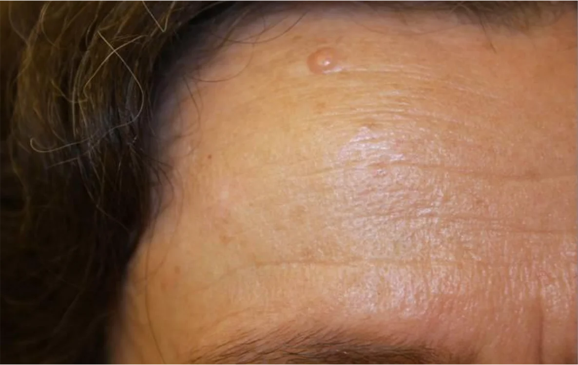 Depois do tratamento com Dermablate, caso clínico 3