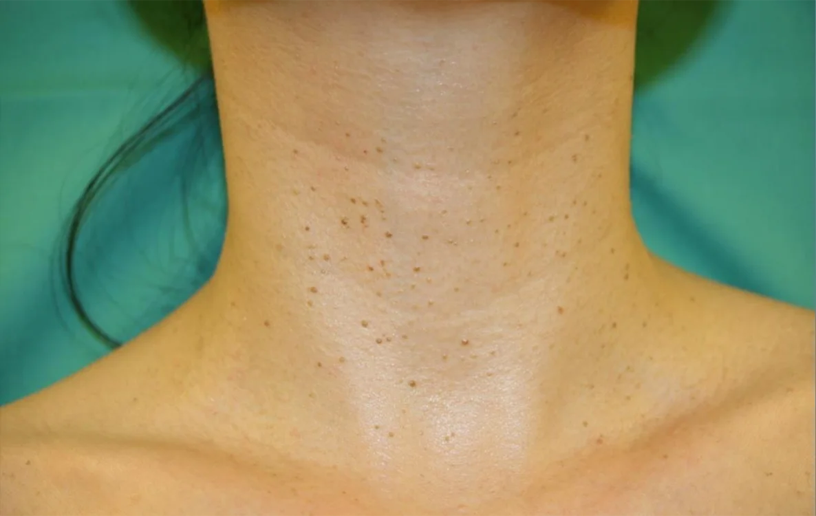 Antes do tratamento com Dermablate, caso clínico 4