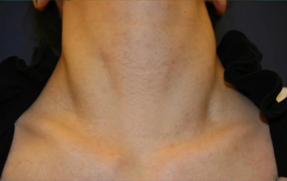 Depois do tratamento com Dermablate, caso clínico 4