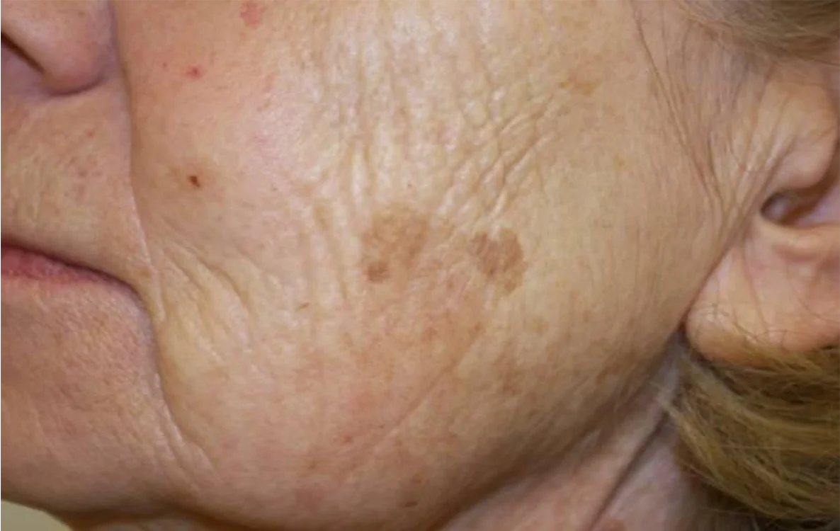Antes do tratamento com Dermablate, caso clínico 5