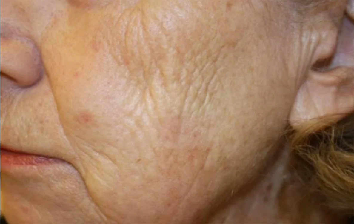 Depois do tratamento com Dermablate, caso clínico 5