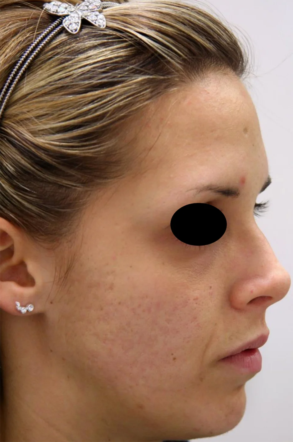 Antes do tratamento com Dermablate, caso clínico 6