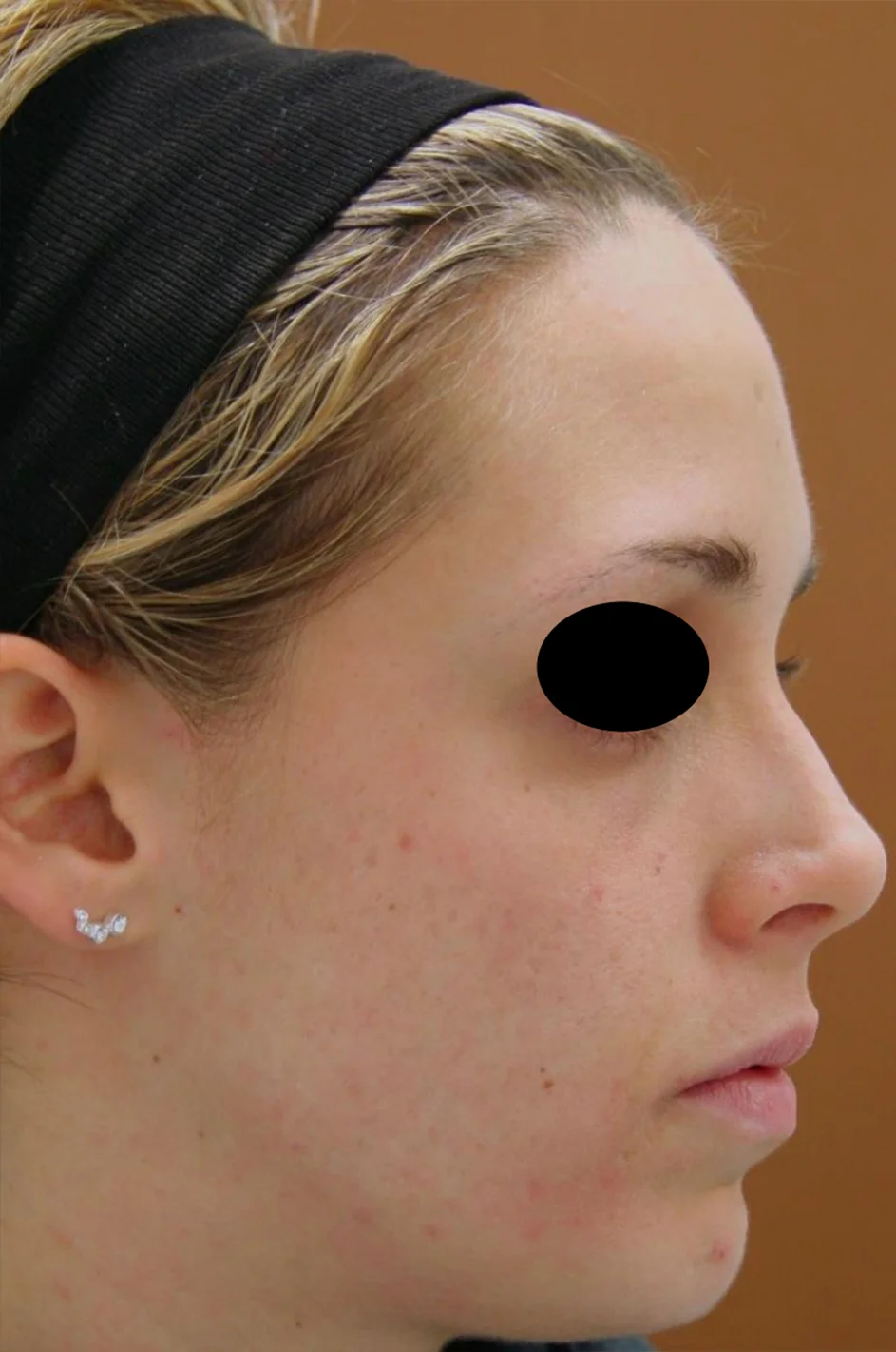 Depois do tratamento com Dermablate, caso clínico 6